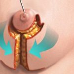 انواع روشهای جراحی کوچک کردن سینه یا ماموپلاستی در زنان