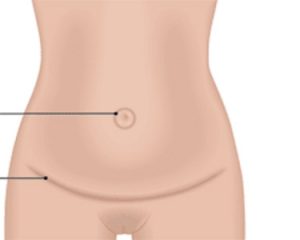 ابدومینوپلاستی جراحی کوچک کردن شکم