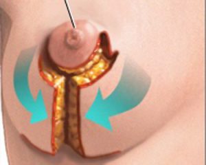 انواع روشهای جراحی کوچک کردن سینه یا ماموپلاستی در زنان