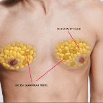 بیماری ژنیکوماستی یا بزرگی سینه ها در مردان و روشهای رایج جراحی