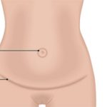 ابدومینوپلاستی جراحی کوچک کردن شکم