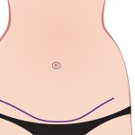 عوارض جراحی کوچک کردن شکم ابدومینوپلاستی