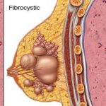 بیماری فیبروکیستیک سینه