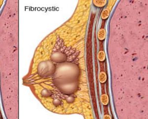 بیماری فیبروکیستیک سینه