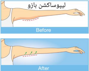 لیپوساکشن بازو جهت رفع چاقی بازو
