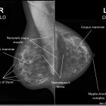 تفسیر ماموگرافی سینه