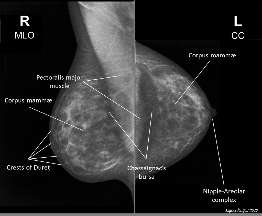 تفسیر ماموگرافی سینه